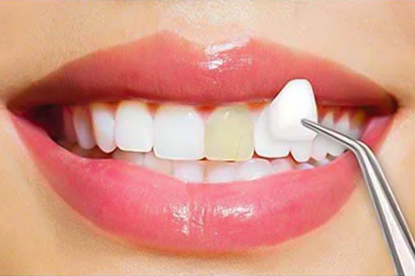 dental veneers 