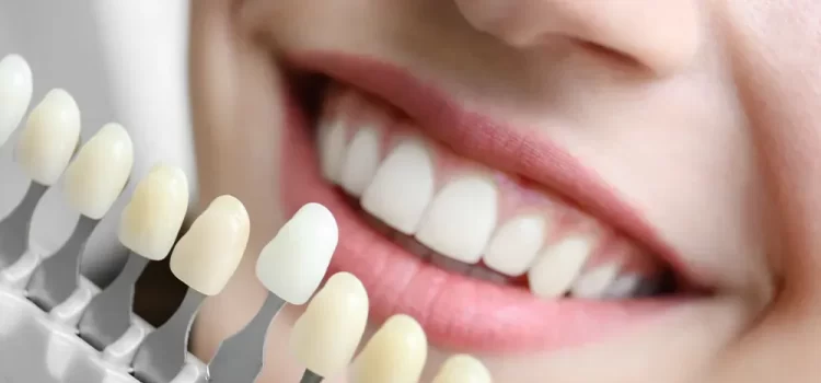 dental veneers