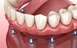 Dental Implants