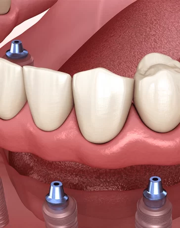 Dental Implants