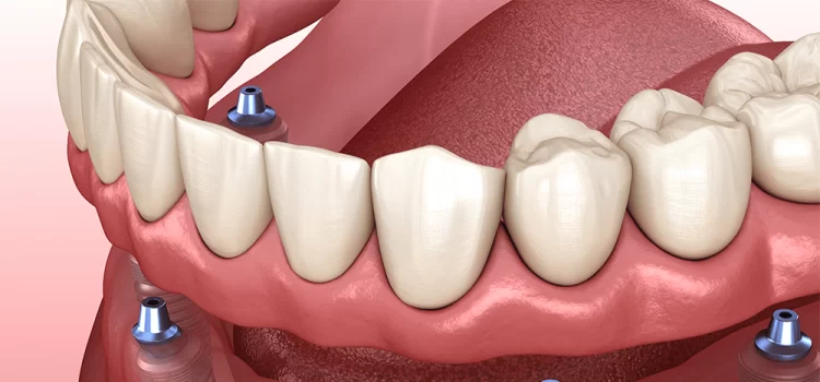 Dental Implants