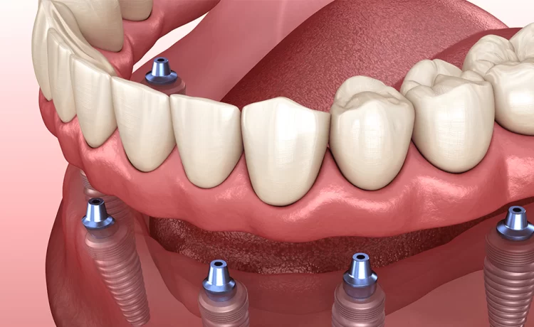 Dental Implants