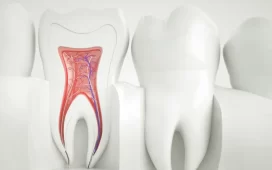 Root Canals