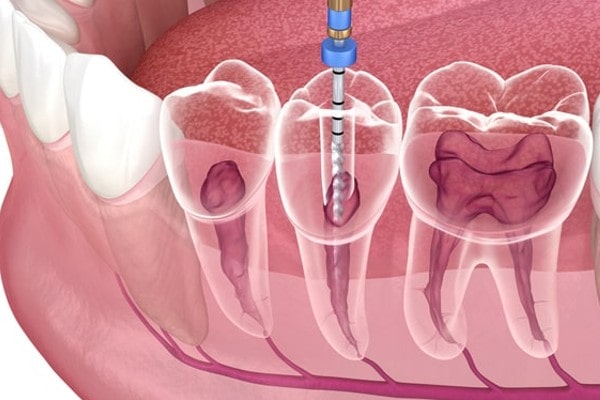 Root Canals