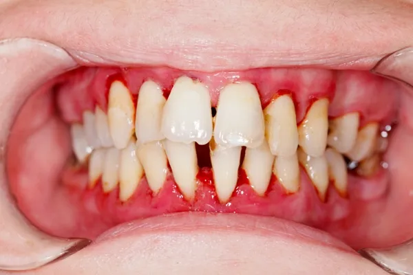 periodontal disease