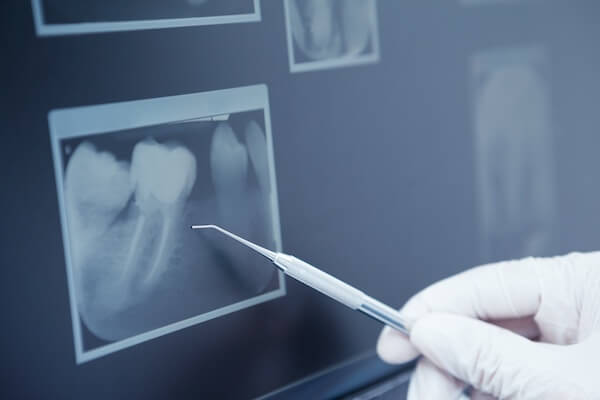 Radiographs in Dentistry